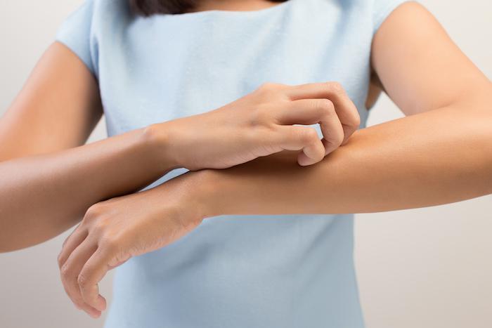 Quercetin and Eczema: Enhancing Skin Health and Reducing Inflammation