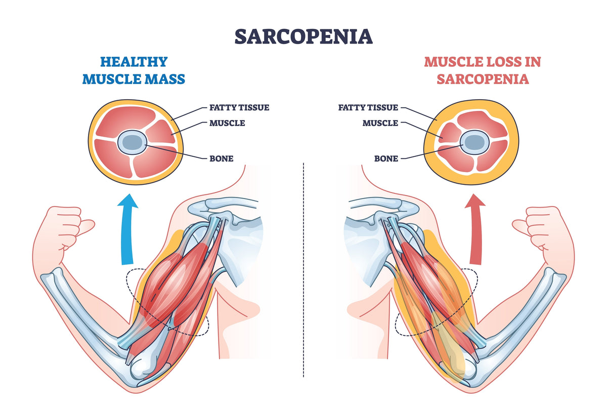 Sarcopenia: The Muscle-Loss Clock You Can Actually Slow